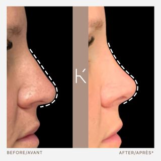 nose job