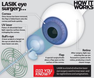 Lasik Eyes Surgery