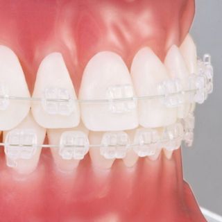 Braces.